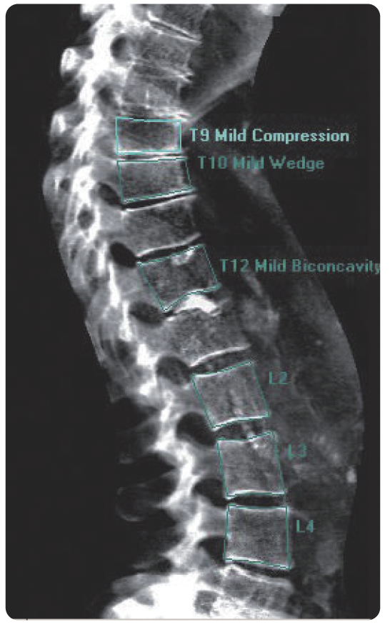 IDXA scan lumbar lateral